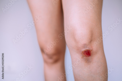 Woman suffering from bleeding wound on her knee on white blackground,Scab becomes Infected