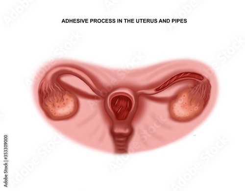 Illustration of the adhesive process in the uterus and tubes. Infertility photo