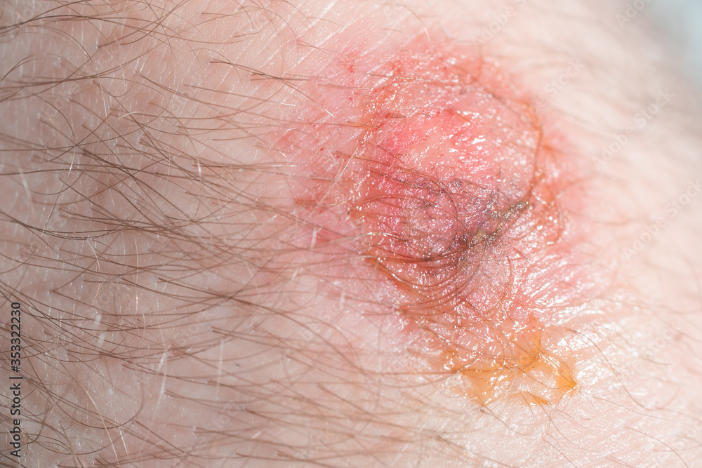 Fototapeta premium Scar of strong man on leg from closeup view