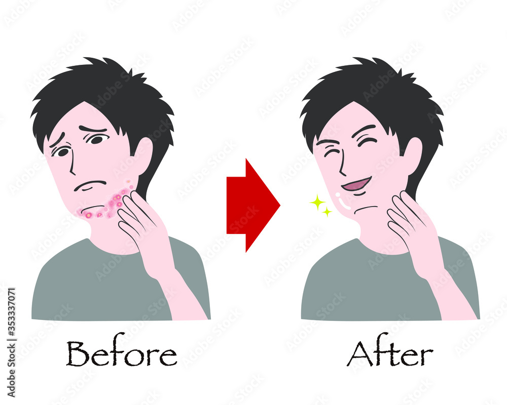 68 Best 剃刀負け Images Stock Photos Vectors Adobe Stock 68 Best 剃刀負け Images Stock Photos Vectors Adobe Stock
