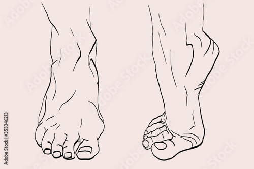 foot drawn with podiatry problems. Fingers and nails to be restored for the podiatrist. Linear illustration