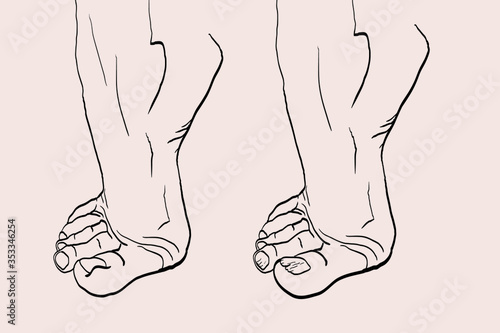 foot drawn with podiatry problems. Fingers and nails to be restored for the podiatrist. Linear illustration