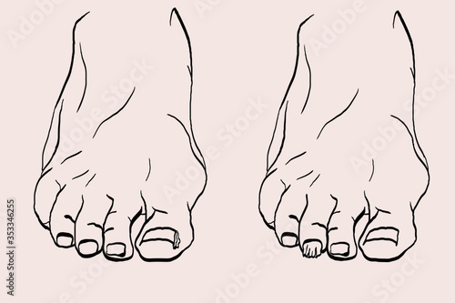 foot drawn with podiatry problems. Fingers and nails to be restored for the podiatrist. Linear illustration