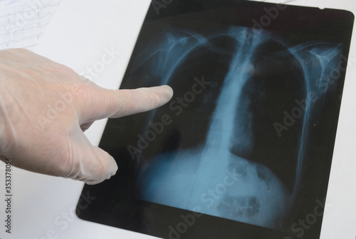 The doctor's hand in a medical glove points his finger at a fluorographic image of the patient's lungs.Diagnostics for coronavirus infection. photo