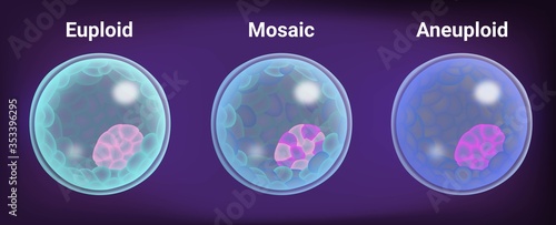 Embryo selection of human blastocyst after preimplantation genetic testing for aneuploidy from a biopsy taken after IVF or ICSI process, 3D illustration
