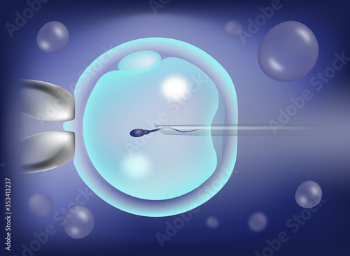 Intracytoplasmic sperm injection, ICSI, as part of IVF process