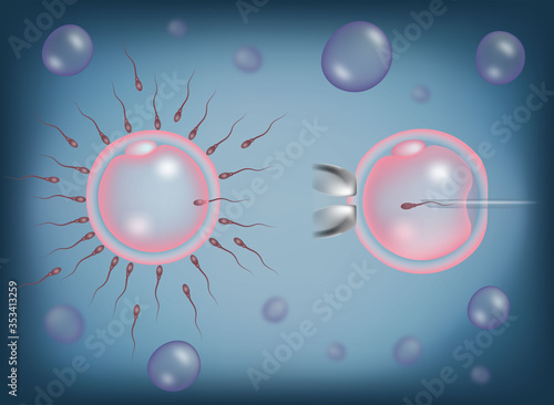 Intracytoplasmic sperm injection, ICSI, process versus In vitro fertilization process, IVF, 3D illustration