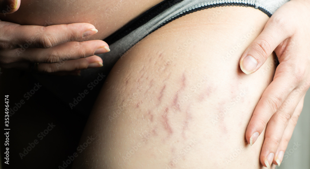 Fresh stretch marks on thigh of a pregnant caucasian woman. Cosmetic skin  problem after pregnancy, possible to erase with laser theraphy. Stock-Foto  | Adobe Stock