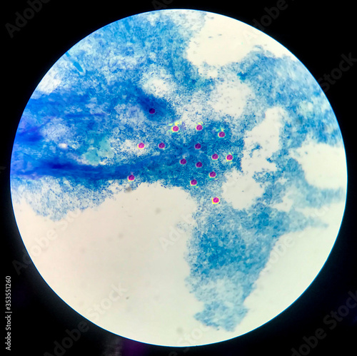 Red cell on blue background cryptococcus in HIV patients. photo