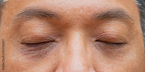 Skin face problem of asian man 40s, age  .Middle aged man has under eye dark circles