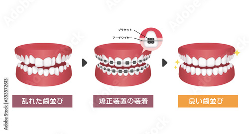 歯列矯正・歯の矯正のプロセス　ベクターイラスト