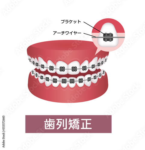 歯列矯正・歯の矯正のプロセス　ベクターイラスト