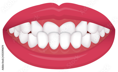 Teeth trouble ( bite type / crooked teeth ) vector illustration  /Underbite