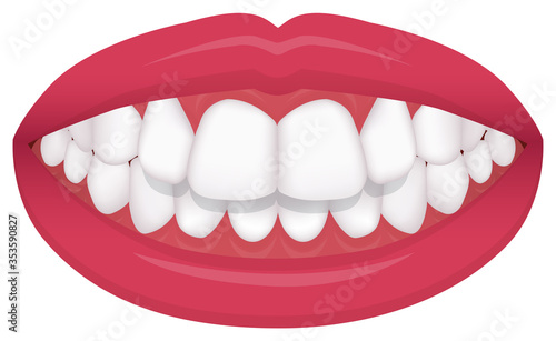 Teeth trouble ( bite type / crooked teeth ) vector illustration /Overbite (Back teeth)