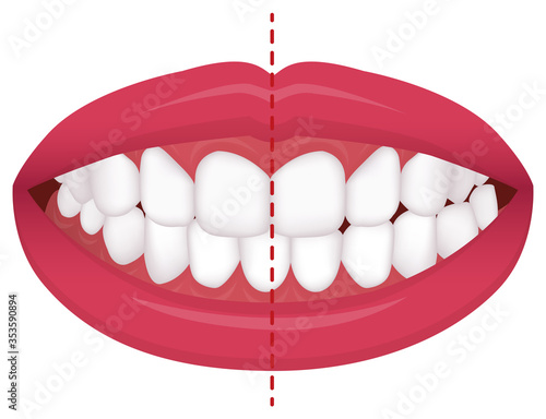 Teeth trouble ( bite type / crooked teeth ) vector illustration  /Crossbite (misalignment)