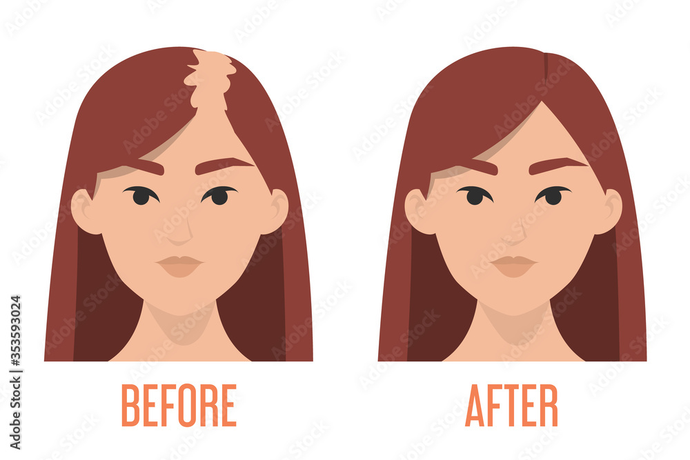 Hait transplantation before and after vector isolated Hait transplantation before and after vector isolated