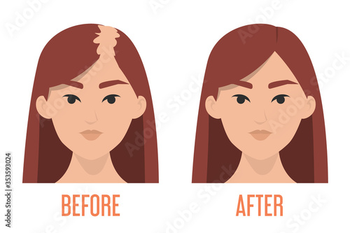 Hait transplantation before and after vector isolated