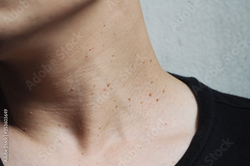 Many skin tags or Acrochordon on the neck of an Asian male.They are small soft and common benign on the human skin especially on adult skin and can be irritated by shaving and daily clothing