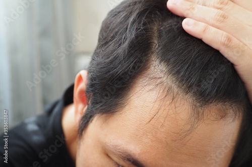 Young Asian man using his hand slicking his hair back after facing hair loss problem by taking medicine like zinc and biotin to make his hair grow faster and thicker. Men health and medical concept