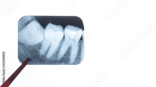 gloved dentist surgeon holds x-ray of lower retarded wisdom tooth. Film noise effect