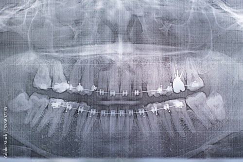 X-ray photograph of human teeth with a braces system. Retarded Wisdom Tooth. Film noise effect