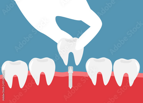 Dental implantation concept. Dentist hand fixing tooth implant. Isolated on blue background. Vector Illustration.