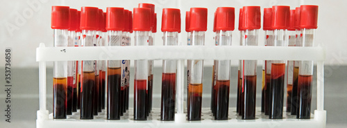 A medical laboratory takes a blood sample and tests for covid