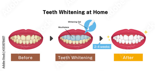 Teeth whitening vector illustration / before and after