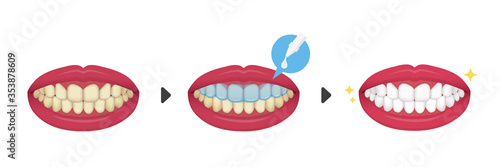Teeth whitening vector illustration / before and after (No text)