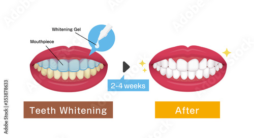 Teeth whitening vector illustration / before and after