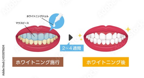 歯のホワイトニング（ホームホワイトニング）のながれ　ベクターイラスト 