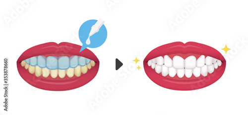 Teeth whitening vector illustration / before and after (No text)