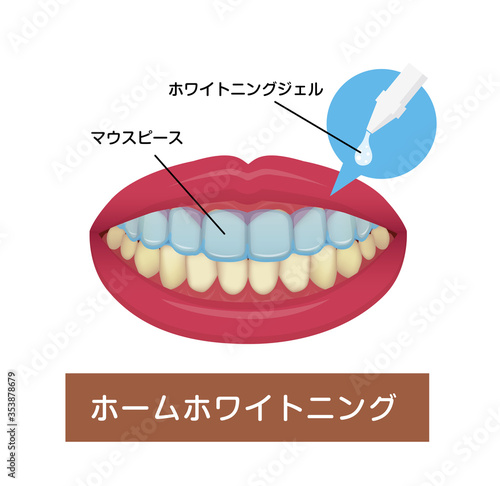 歯のホワイトニング（ホームホワイトニング）ベクターイラスト 