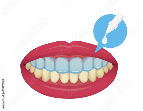 Teeth whitening at home vector illustration / no text