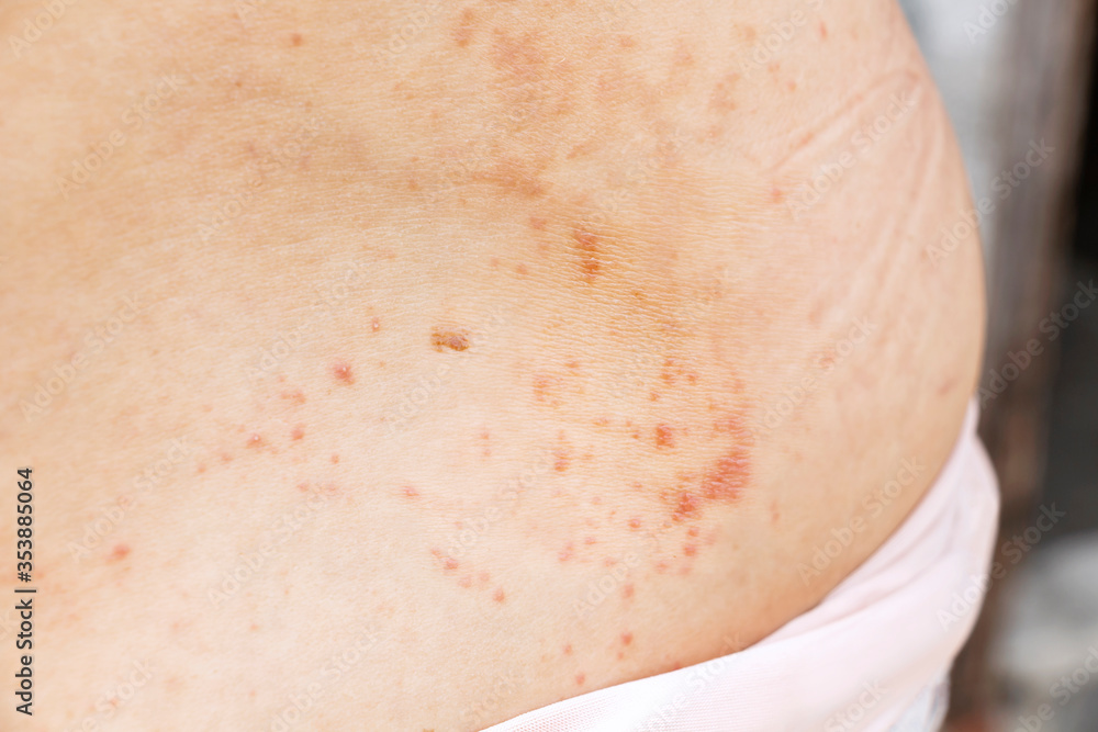 Skin disease prickly heat rash or miliaria on back skin of asian woman
