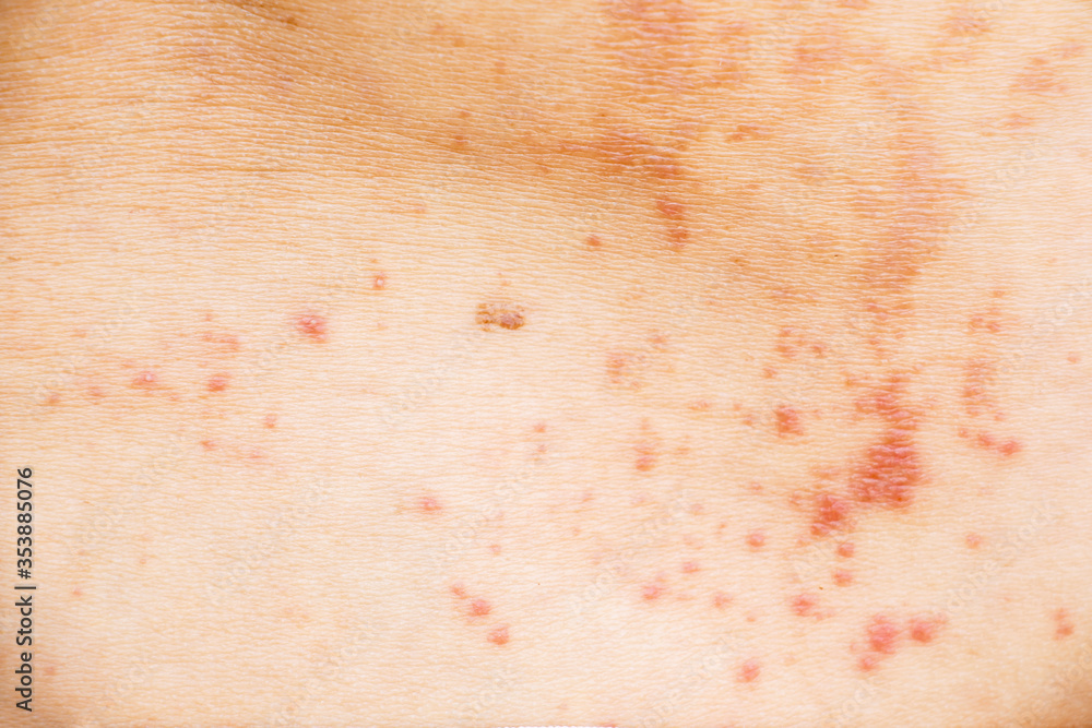 Skin disease prickly heat rash or miliaria on back skin of asian woman