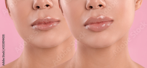 Woman before and after lip correction procedure, closeup. Banner design