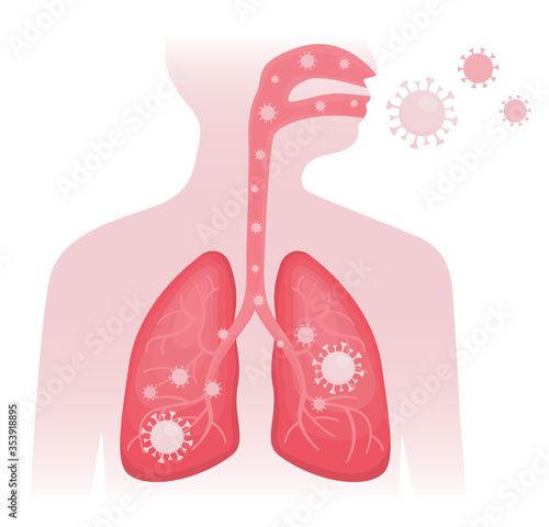 Flat vector illustration of infected human lungs with viral pneumonia and coronavirus on white background. Person breathing and spreading covid. Stop pandemic, detail outline of anatomy isolated.