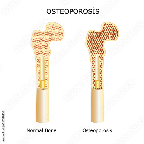 Bone structure in osteoporosis patients