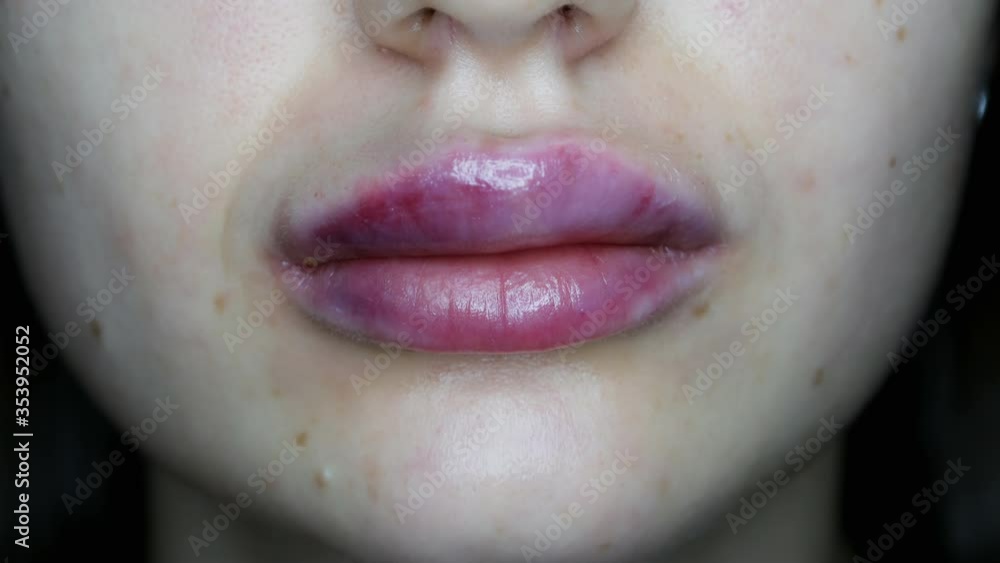 Macro close-up of swollen lips after injections of hyaluron, lips augmentation Macro close-up of swollen lips after injections of hyaluron, lips augmentation