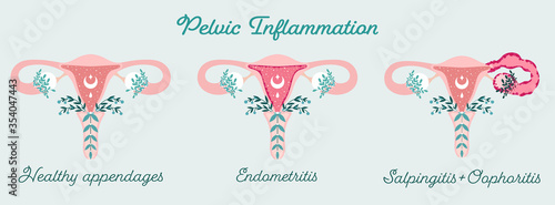 Pelvic Inflammation - Floral Infographic. Endometritis, Oophoritis, Salpingitis. Women health. Edema of uterus - Patient-friendly scheme. Gynecological Problems - Neutral medical diagram