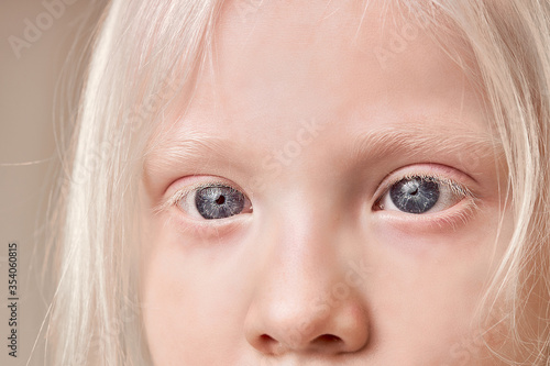 Slika na platnu close-up photo of beautiful blue eyes of albino child girl looking side