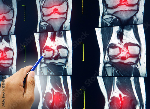Magnetic resonance (MRI) of right knee.Close up hand doctor holding a pen and Explain the results to the patient to know Magnetic resonance (MRI) of right knee.
 photo