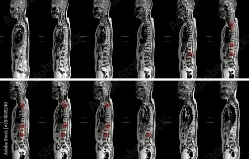 MRI OF THORACOLUMBAR SPINE IMPRESSION:  Moderate pathological compression of T11 and L2 levels with enhancing multiple marrow lesions at  T1, T10 toT12, L2, L3 to L5 levels. photo