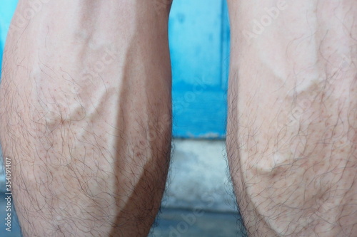 Closeup of bulging and swollen leg veins of a man caused by getting older age or having some exercise making blood pressure rises or when vein valves weaken