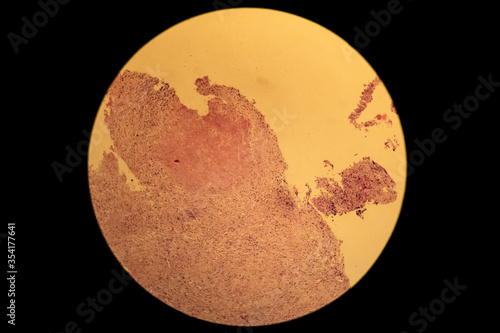 Pleural biopsy pulmonary TB, tuberculosis. Abrahms needle. Granuloma. photo