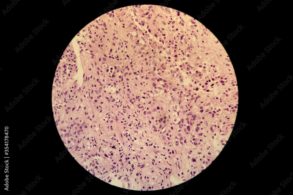 Microscopic slide of lung tumour adenocarcinoma Microscopic slide of lung tumour adenocarcinoma