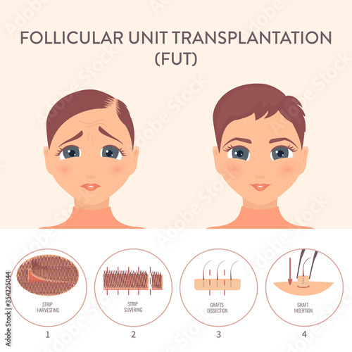 Hair transplant alopecia treatment by FUT. Stages of follicular unit transplantation restoration surgery for women. Health care and medical concept. Vector illustration.