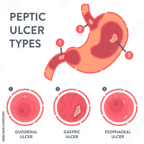 Peptic ulcer stomach disease infographic poster. Endoscopic image of stomach with duodenal, gastric and esophageal PUD. Digestive tract disorder. Health care and medical concept. Vector illustration. 