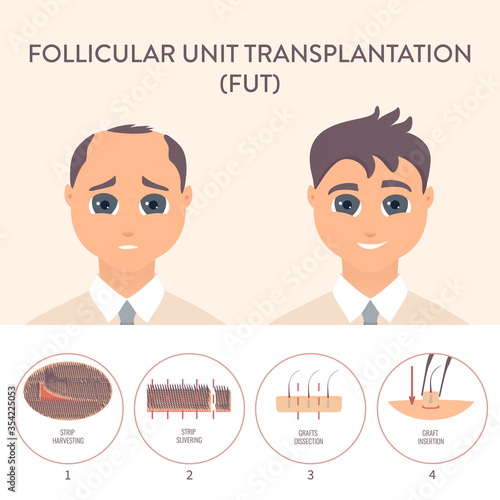 Hair transplant alopecia treatment by FUT. Stages of follicular unit transplantation restoration surgery for men. Health care and medical concept. Vector illustration.